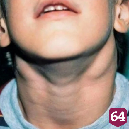 Саратовские врачи спасли ребенка с «болезнью поцелуев»